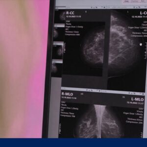 Mammogram screenings declining in key groups of younger women
