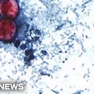 Cases of illness that causes explosive diarrhea on the rise across the U.S.